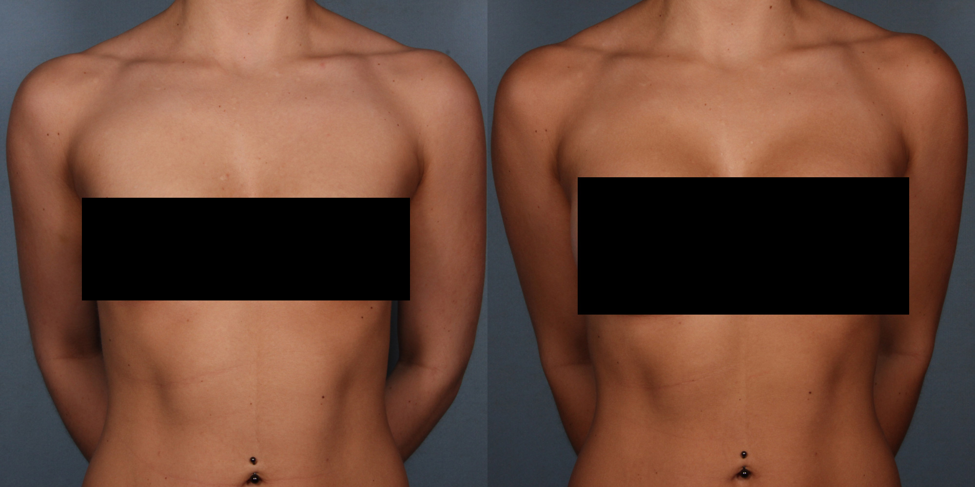 Before And After of Breast Implants In Columbia SC - Breast Augmentation