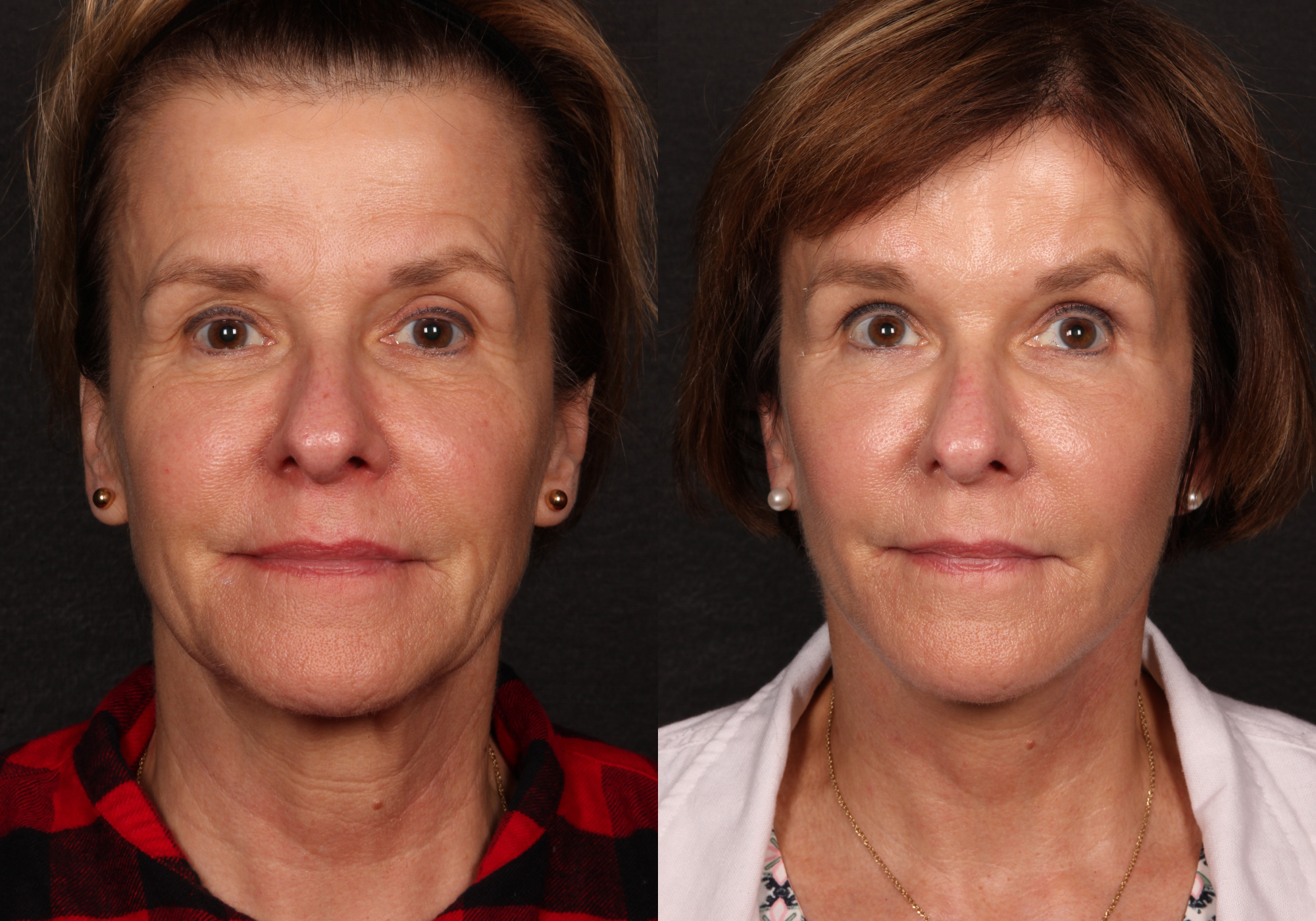 Facelift in Columbia, SC - Lexington, Chapin, Forest Acres