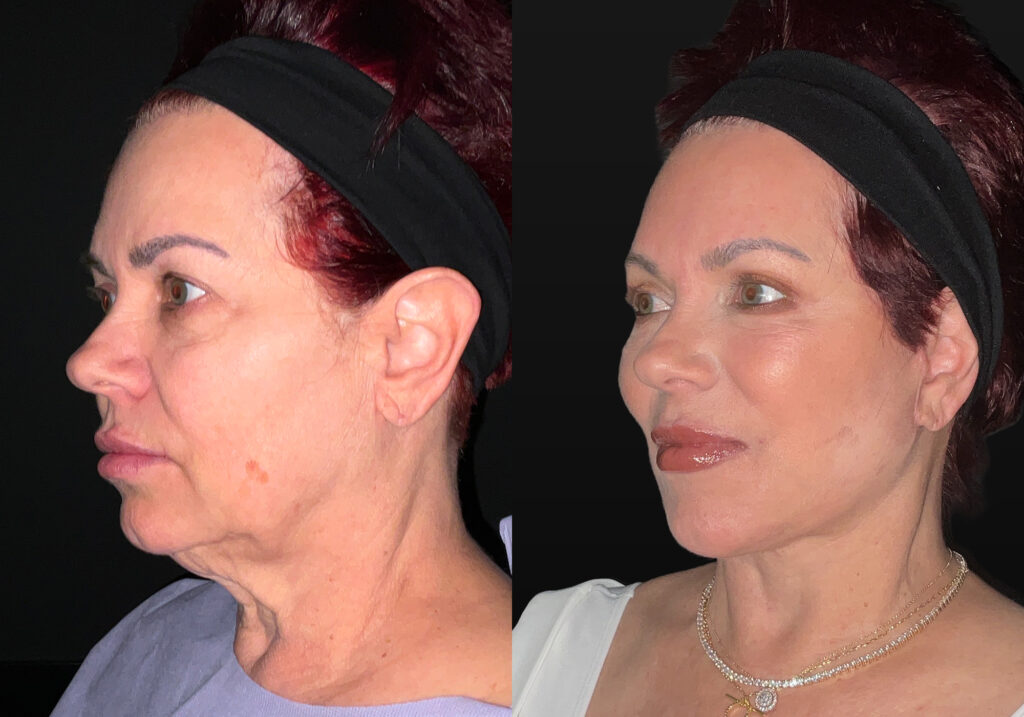 Facelift - Lefkowitz Plastic Surgery and Aesthetics