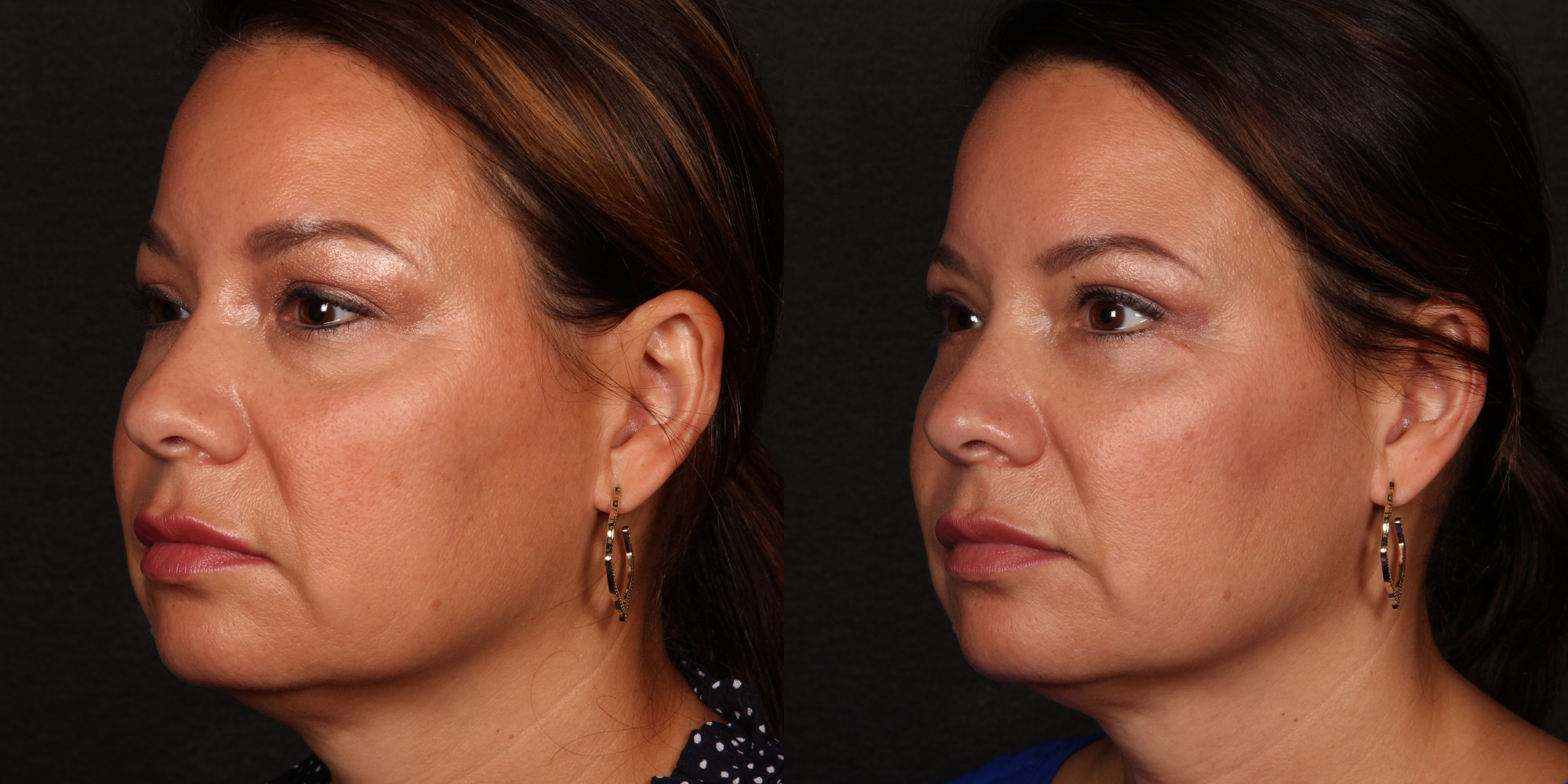 Lower Blepharoplasty - Lefkowitz Plastic Surgery And Aesthetics